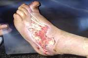 Stem cells created from diabetic foot ulcer cells might yield therapy for chronic wounds